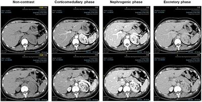 Solitary fibrous tumor of the adrenal gland: a case report and review of the literature